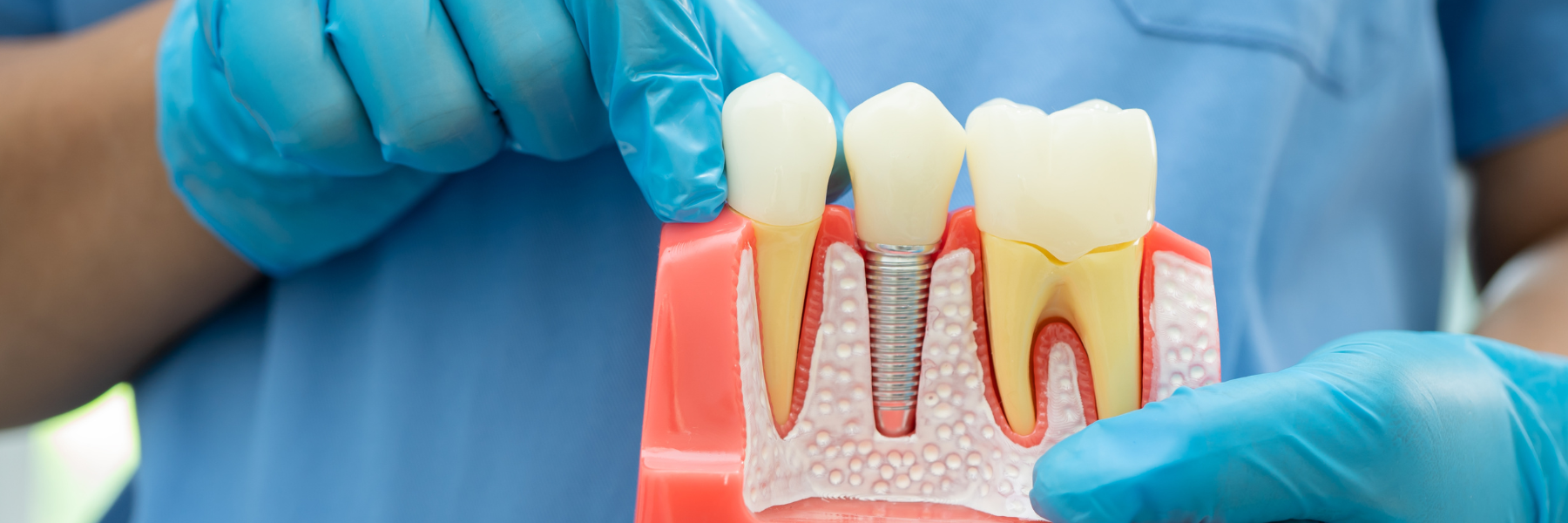 Dental Implants | Dentist